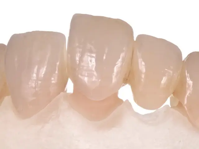 Celtra Duo Veneers