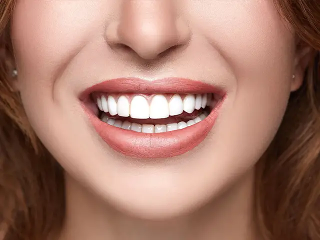 Celtra Duo Veneers