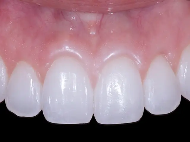 Celtra Duo Veneers