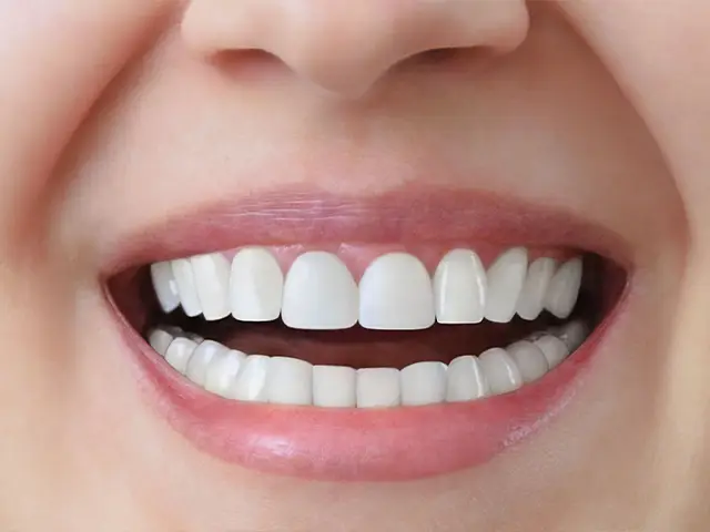 Dental Crowns - OGN Dental Studio ANTALYA