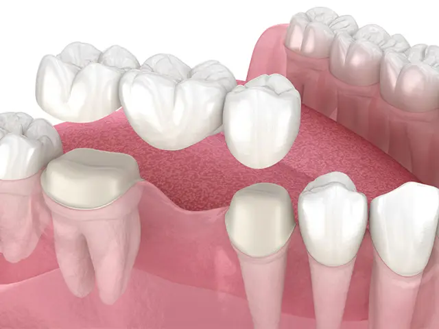 Dental Crowns - OGN Dental Studio ANTALYA