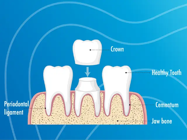 Dental Crowns - OGN Dental Studio ANTALYA