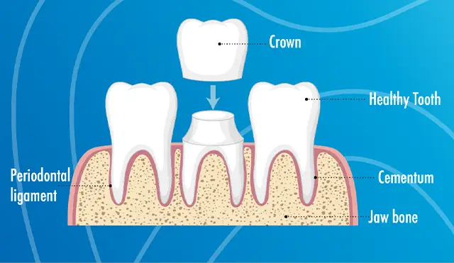 Dental Crowns - OGN Dental Studio ANTALYA