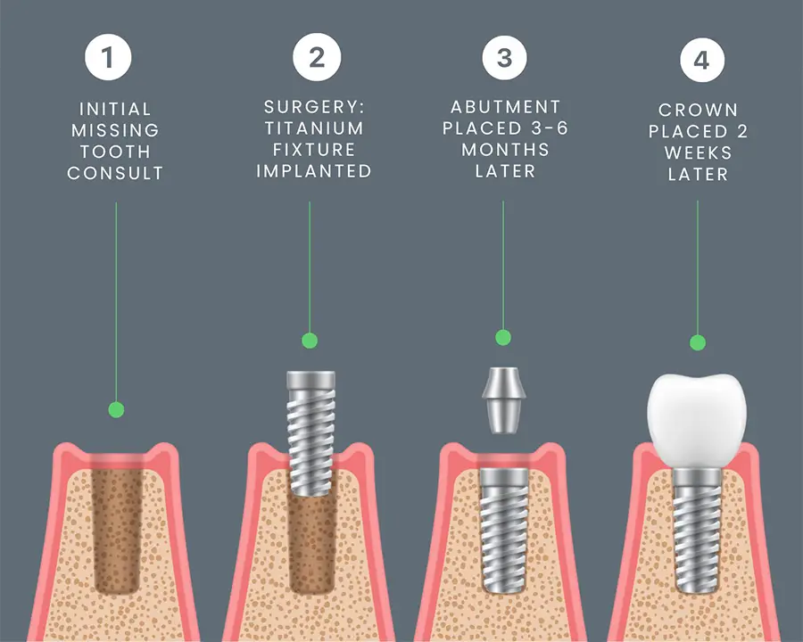 Dental Implantation Process