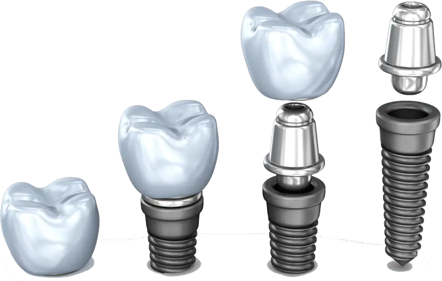 Dental Implant