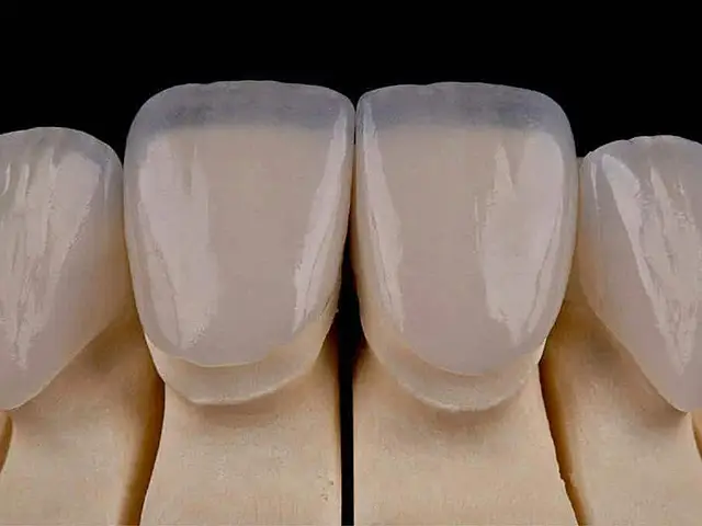 Laminate Veneers - OGN Dental Studio