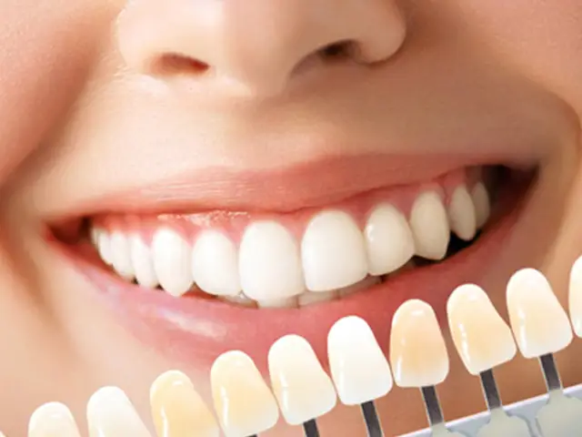 Laminate Veneers - OGN Dental Studio