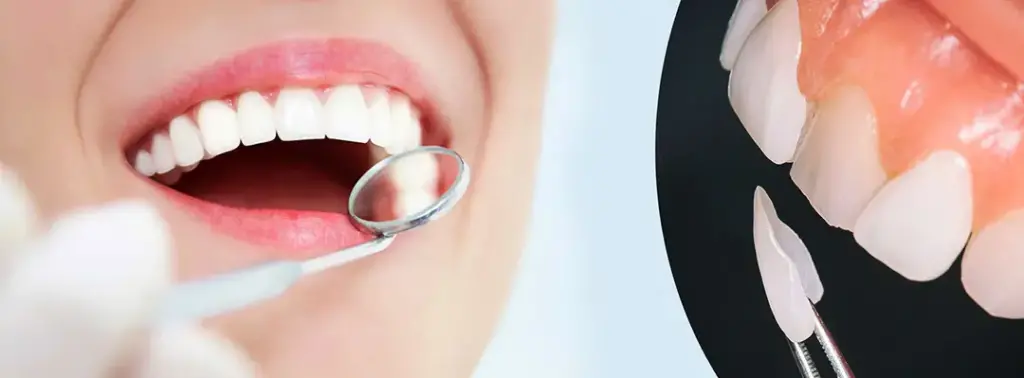 Laminate Veneers - OGN Dental Studio