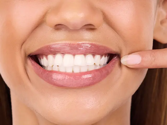 Dental Veneers - OGN Dental Studio Antalya, Turkey