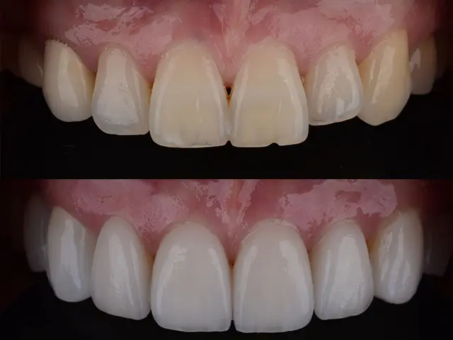Emax Veneers