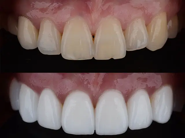 Emax Veneers