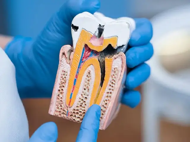 Root Canal Treatment