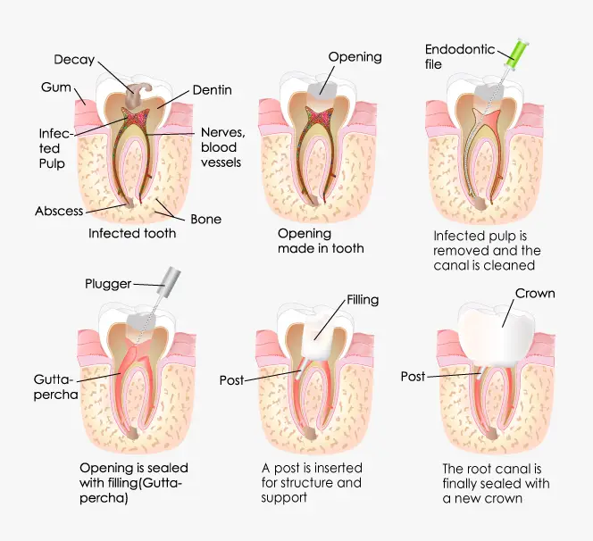 Root Canal Treatment