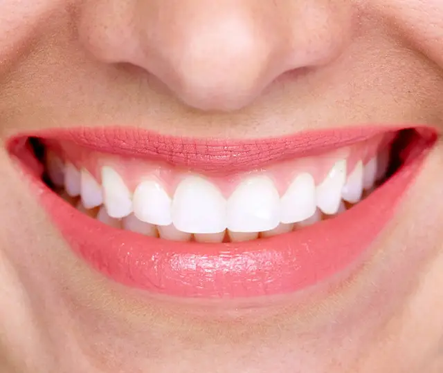 Professional Teeth Whitening