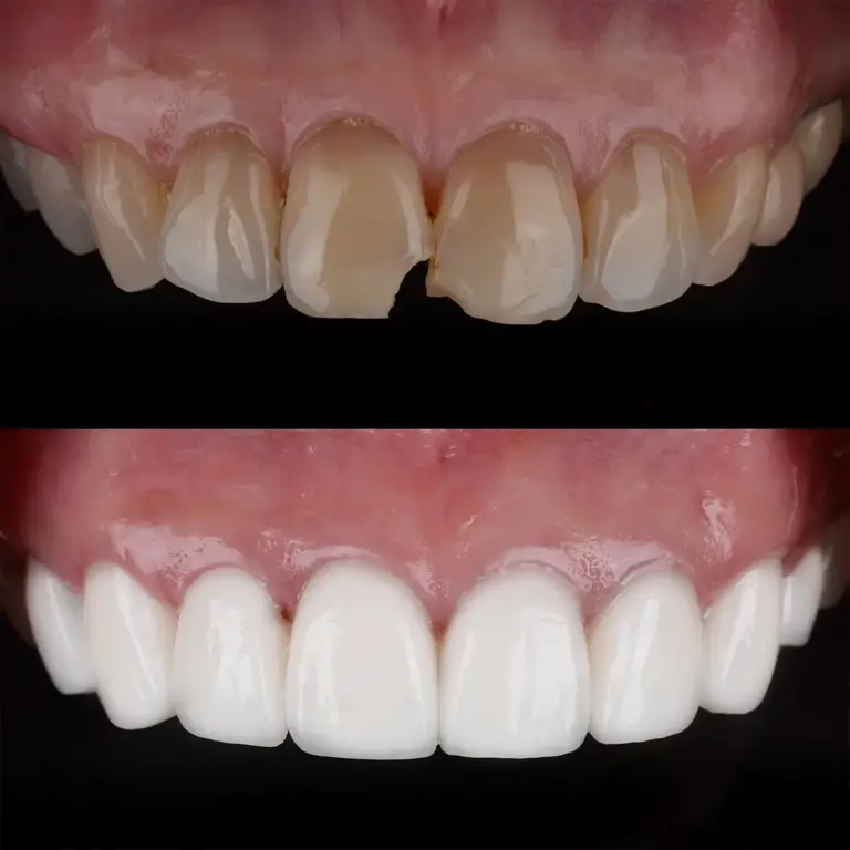 Zirconium Crowns - OGN Dental Studio Antalya