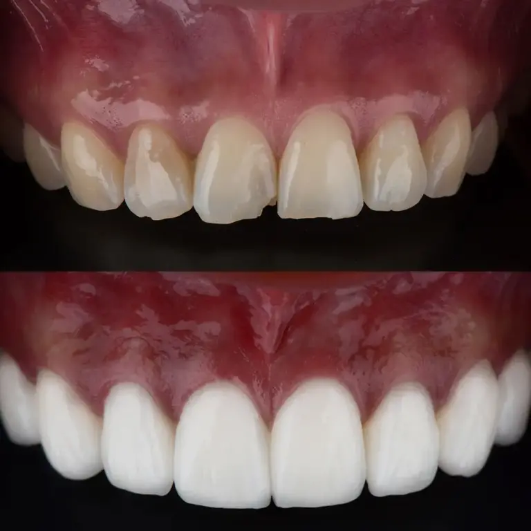 zirconium crowns before after 3