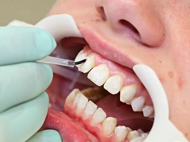 Composite Bonding