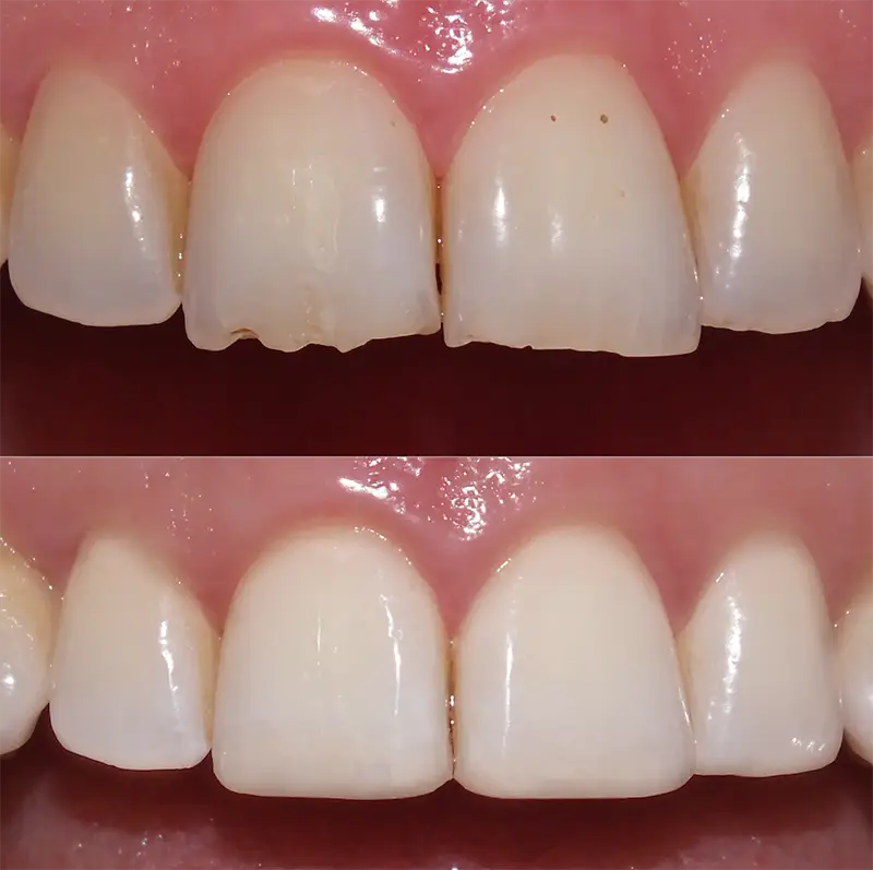 Composite Bonding