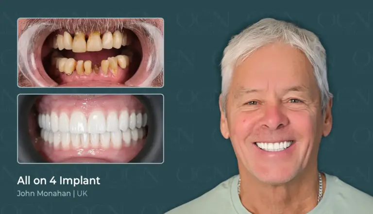 Before & After 6 All on 4 Implant - Before & After