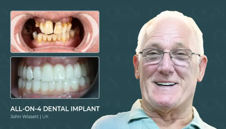 Before & After 10 All on 4 Implant - Before & After