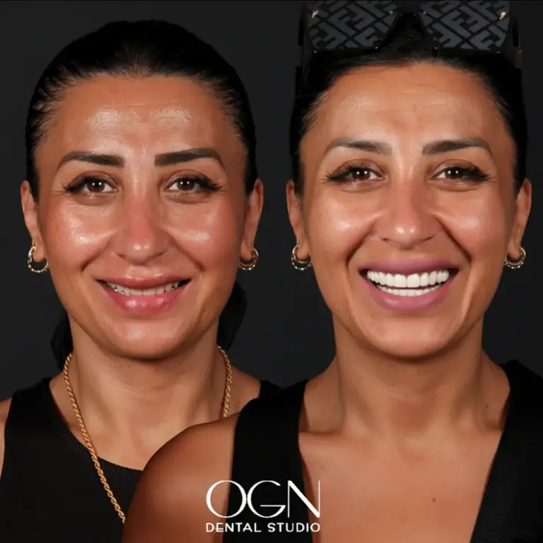 Before & After 14 Before & After - OGN Dental Studio