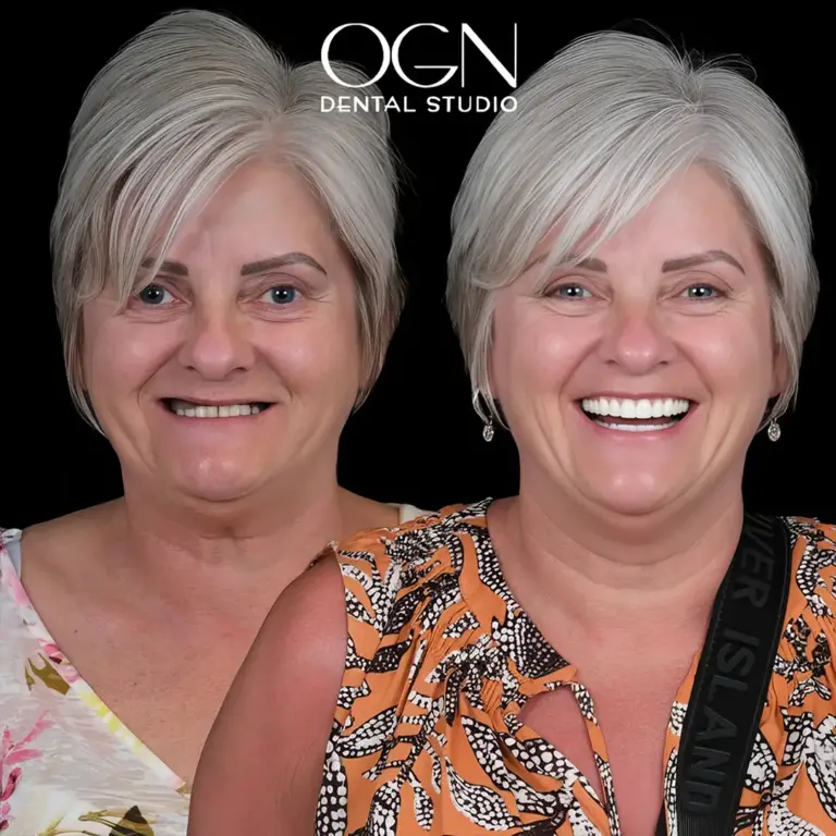 Before & After 13 Before & After - OGN Dental Studio