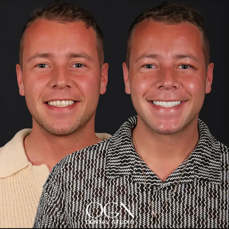 Vorher & Nachher - OGN Dental Studio