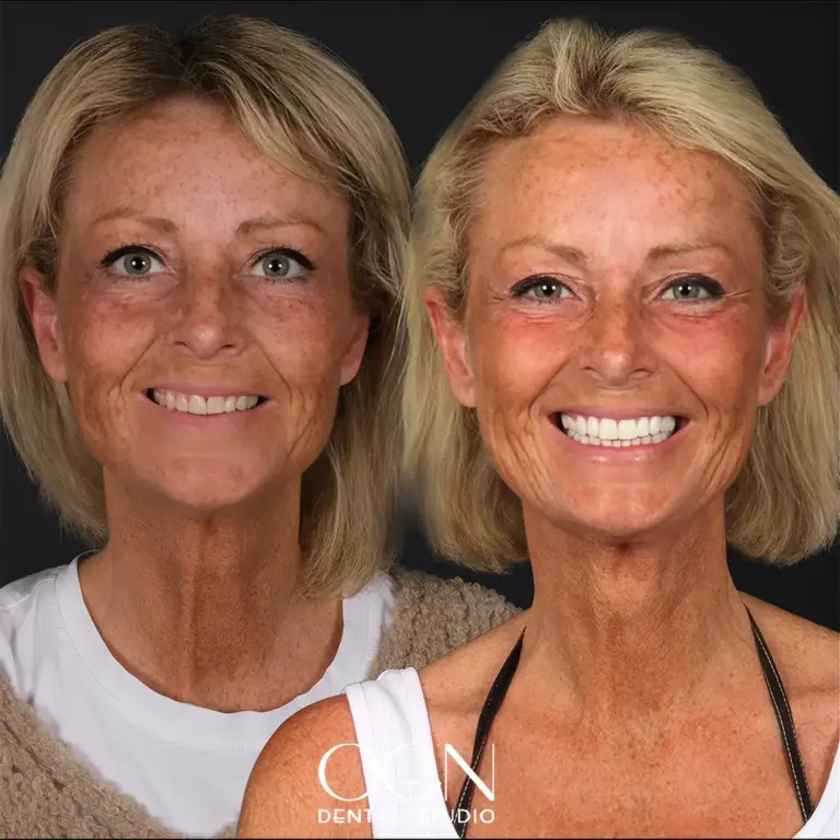 Vorher & Nachher - OGN Dental Studio