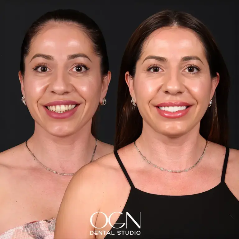 Before & After 16 Before & After - OGN Dental Studio