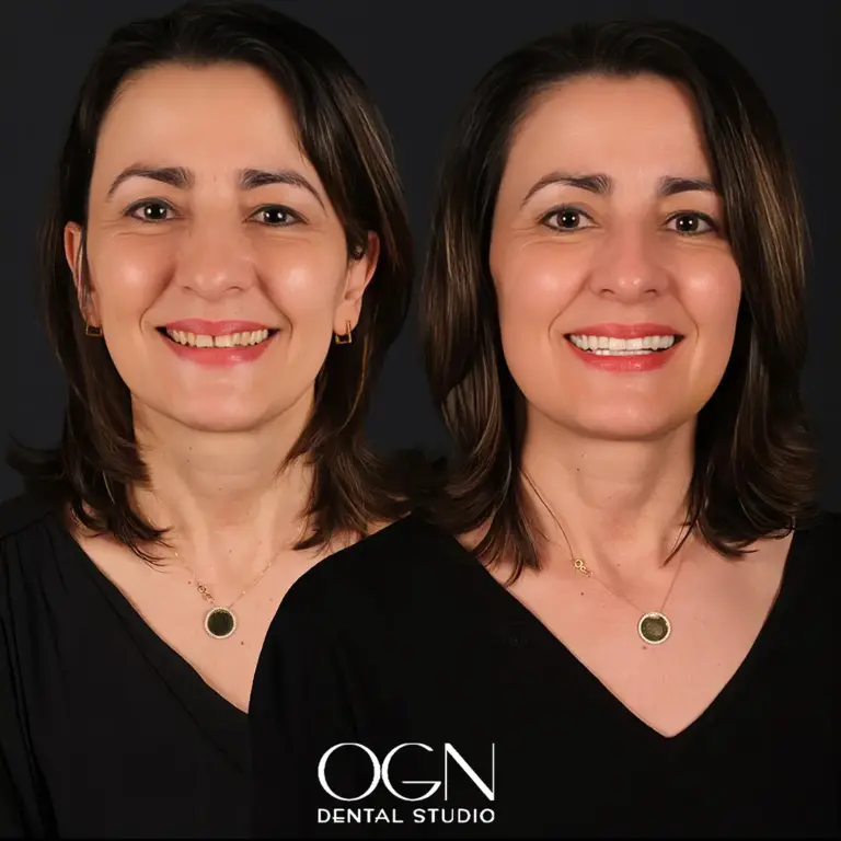 Before & After 17 Before & After - OGN Dental Studio