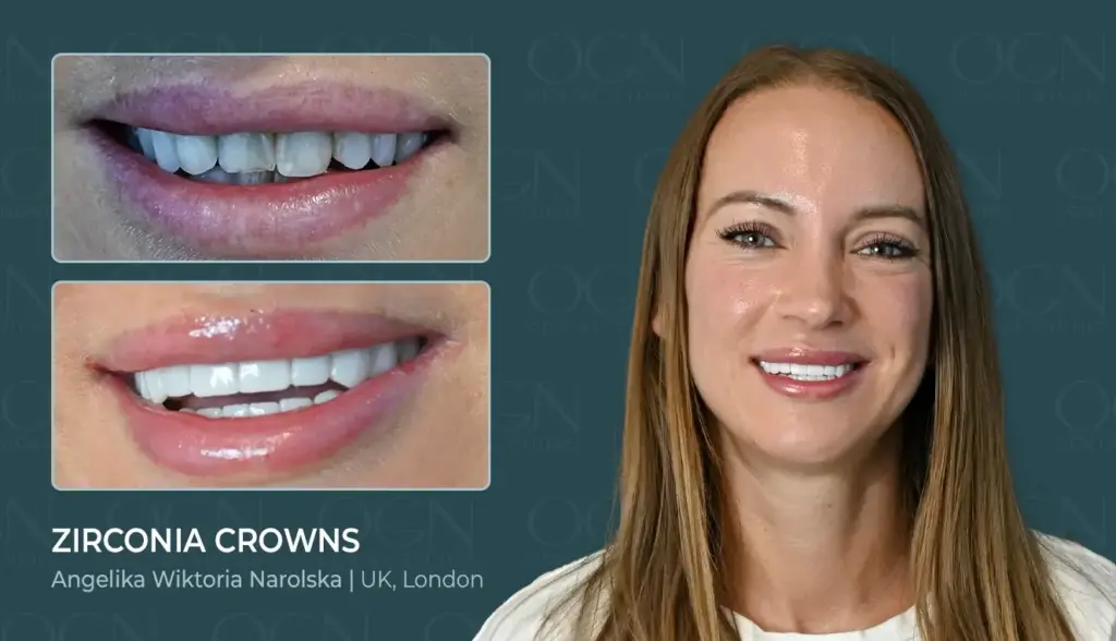 Zirconia Crowns - Before & After