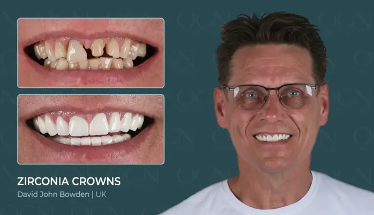 Before & After 8 Zirconia Crowns - Before & After