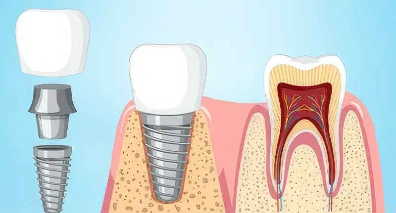 Dental Implant Cost in UK
