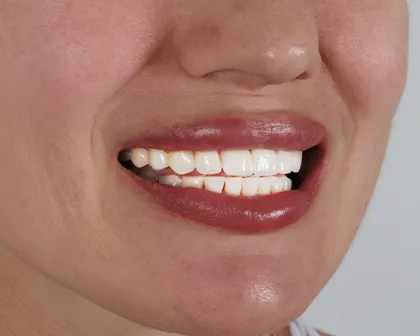 Zahnveneers