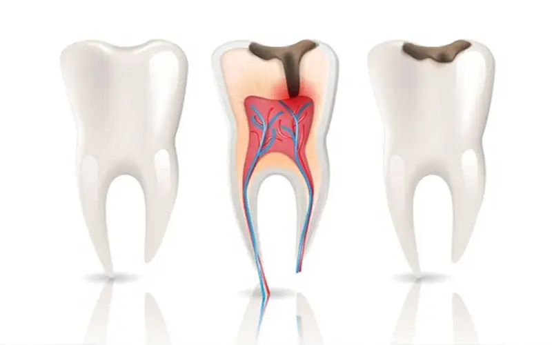 Root Canal Treatment in Turkey