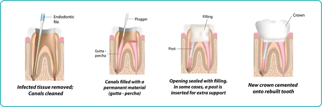 Root Canal Treatment in Turkey