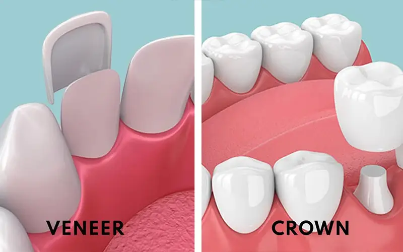 Veneers vs Crowns 1 Veneers vs Crowns