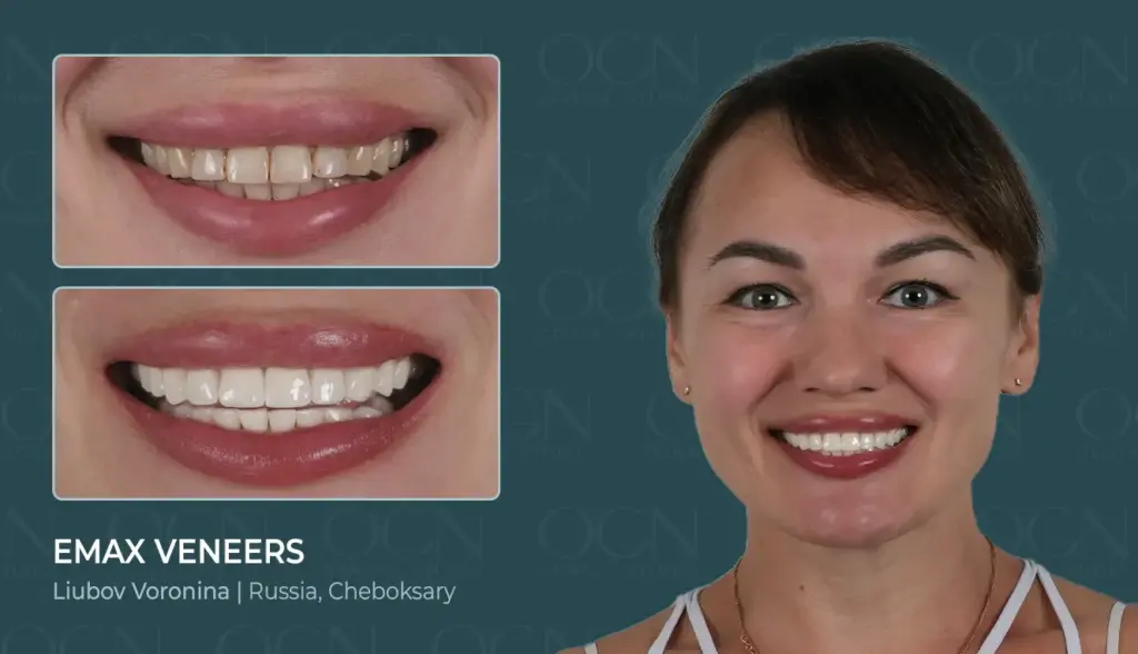 Get Teeth Done in Turkey 20 Emax Veneers - Before & After