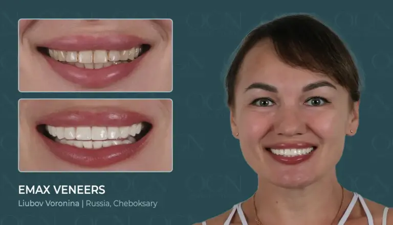 Before & After 11 Emax Veneers - Before & After