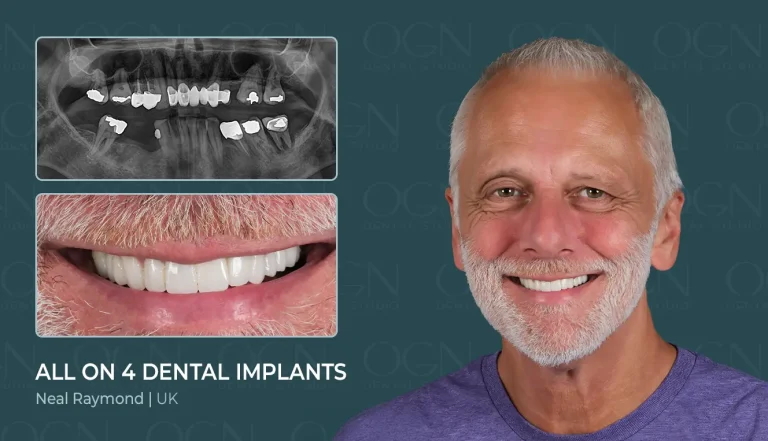 Before & After 4 Before & After - OGN Dental Studio