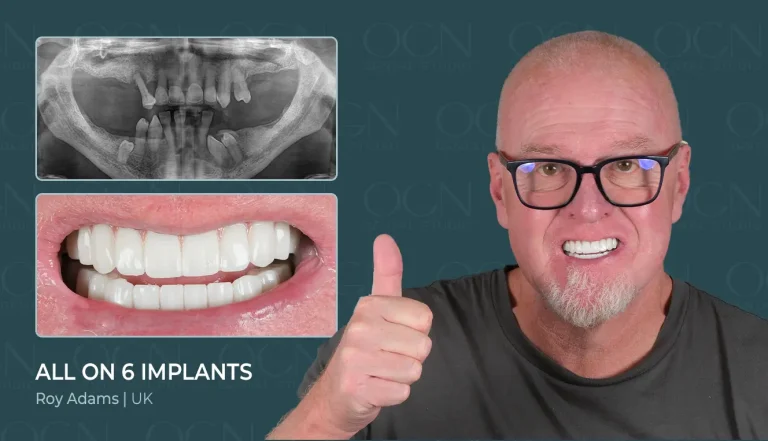 Before & After 3 All on 6 Implant - Before & After