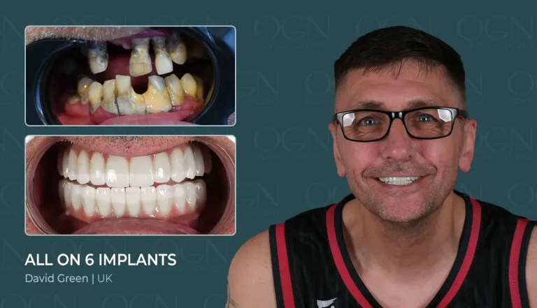 Before & After 1 All on 6 Implant - Before & After