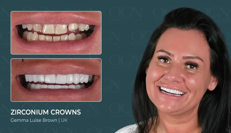 Before & After 2 Zirconia Crowns - Before & After
