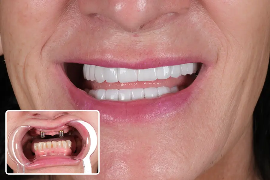 Dental Implant - OGN Dental Studio Antalya
