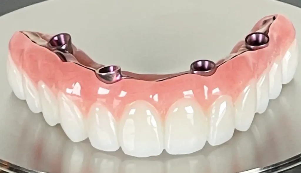 Hybrid Implants in Turkey 1 Hybrid Implants in Turkey
