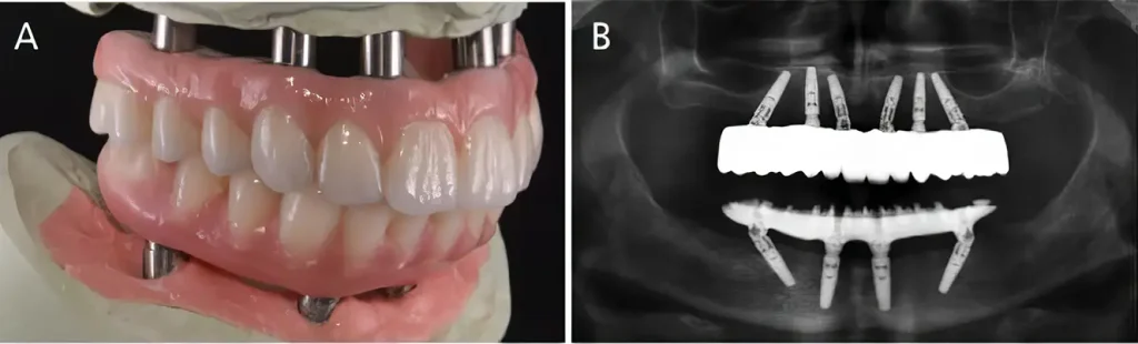 Hybrid Implants in Turkey