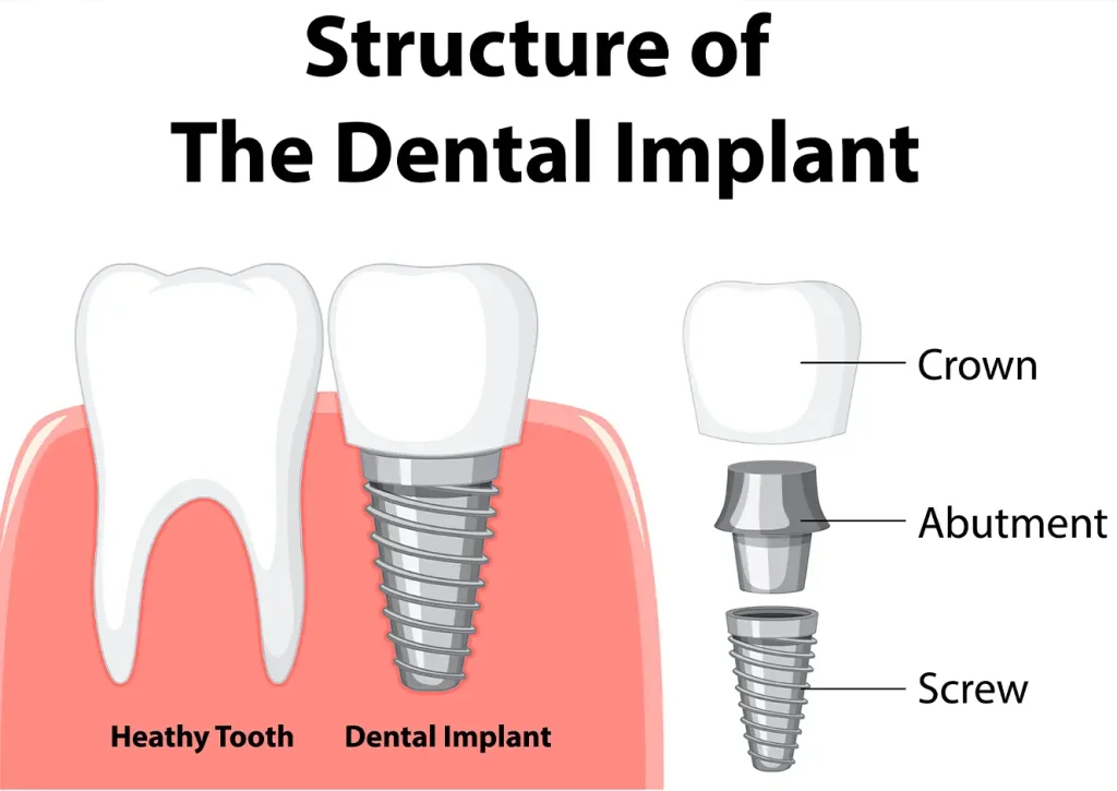 Implant Teeth Look Natural