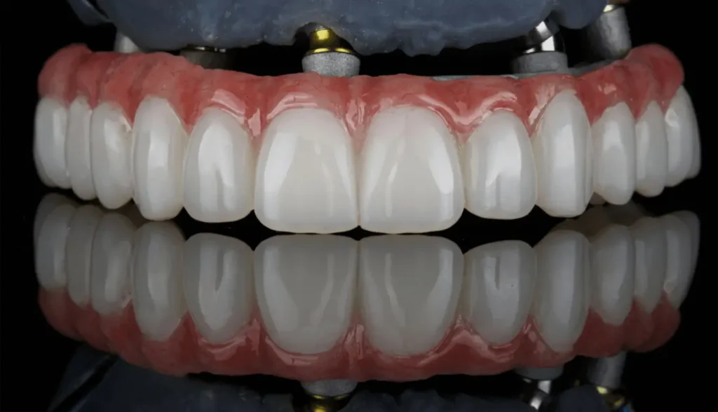 Upper Jaw Dental Implants