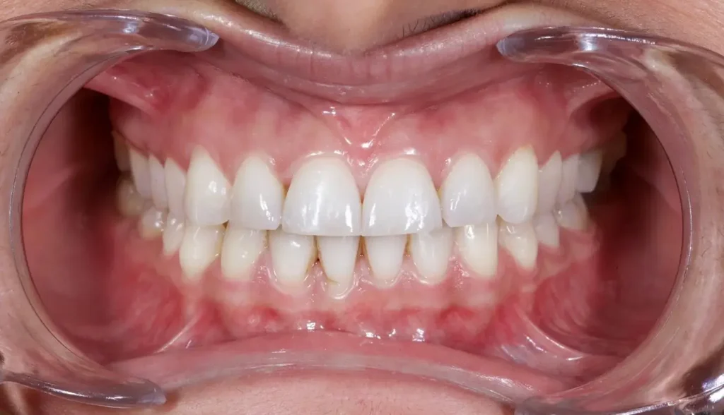 Upper Jaw Dental Implants