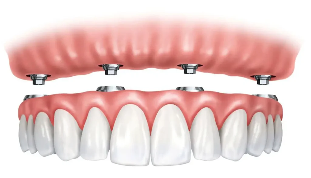 Upper Jaw Dental Implants